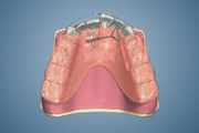 Anterior X-Bite Appliance